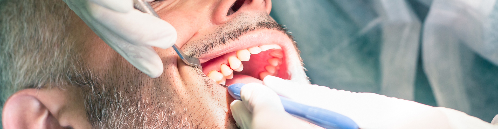 gloved hands holding dental tool in patient's mouth.